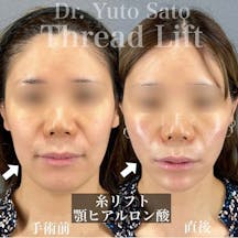 【30代後半女性・たるみ】糸リフト ヒアルロン酸 ボトックス_before_aftar