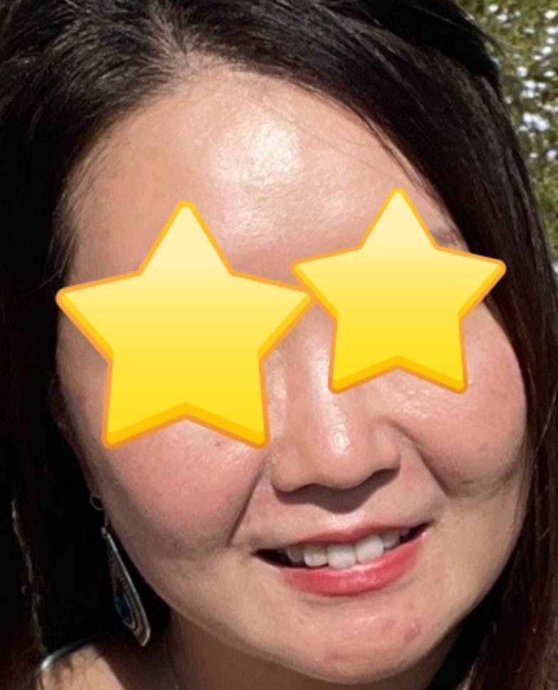 ミケイクリニックでポテンツァを受けたSummyさんの写真