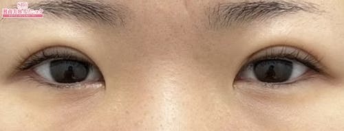 【30代女性・目元】週末二重(R)_after