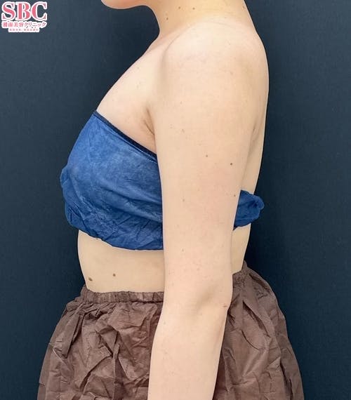 【女性・二の腕】Aquicell(アキーセル)脂肪吸引・根こそぎVASER脂肪吸引_after