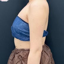 【女性・二の腕】Aquicell(アキーセル)脂肪吸引・根こそぎVASER脂肪吸引_after