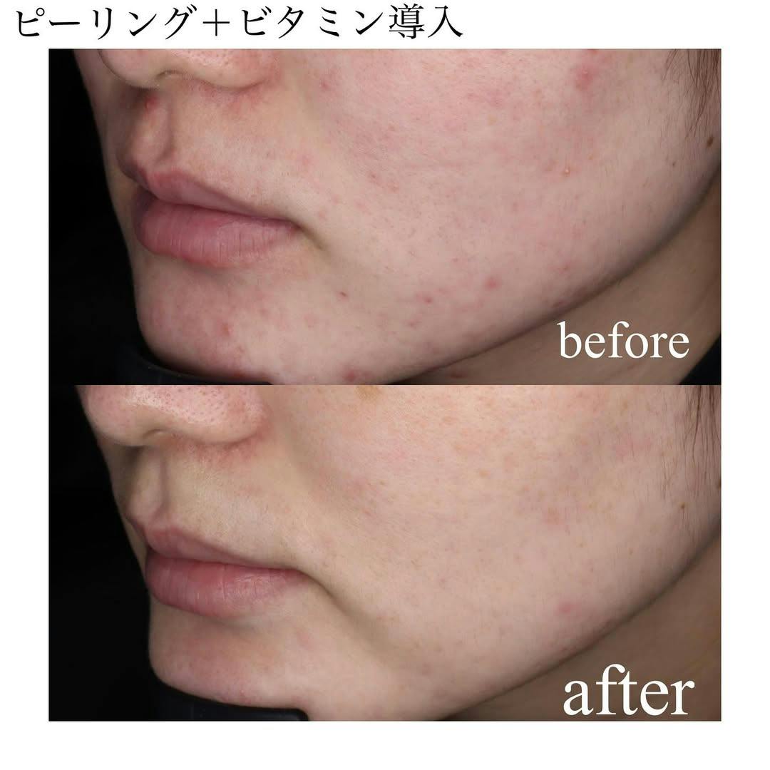 【女性・顔】ピーリング＋ビタミン導入_before_aftar