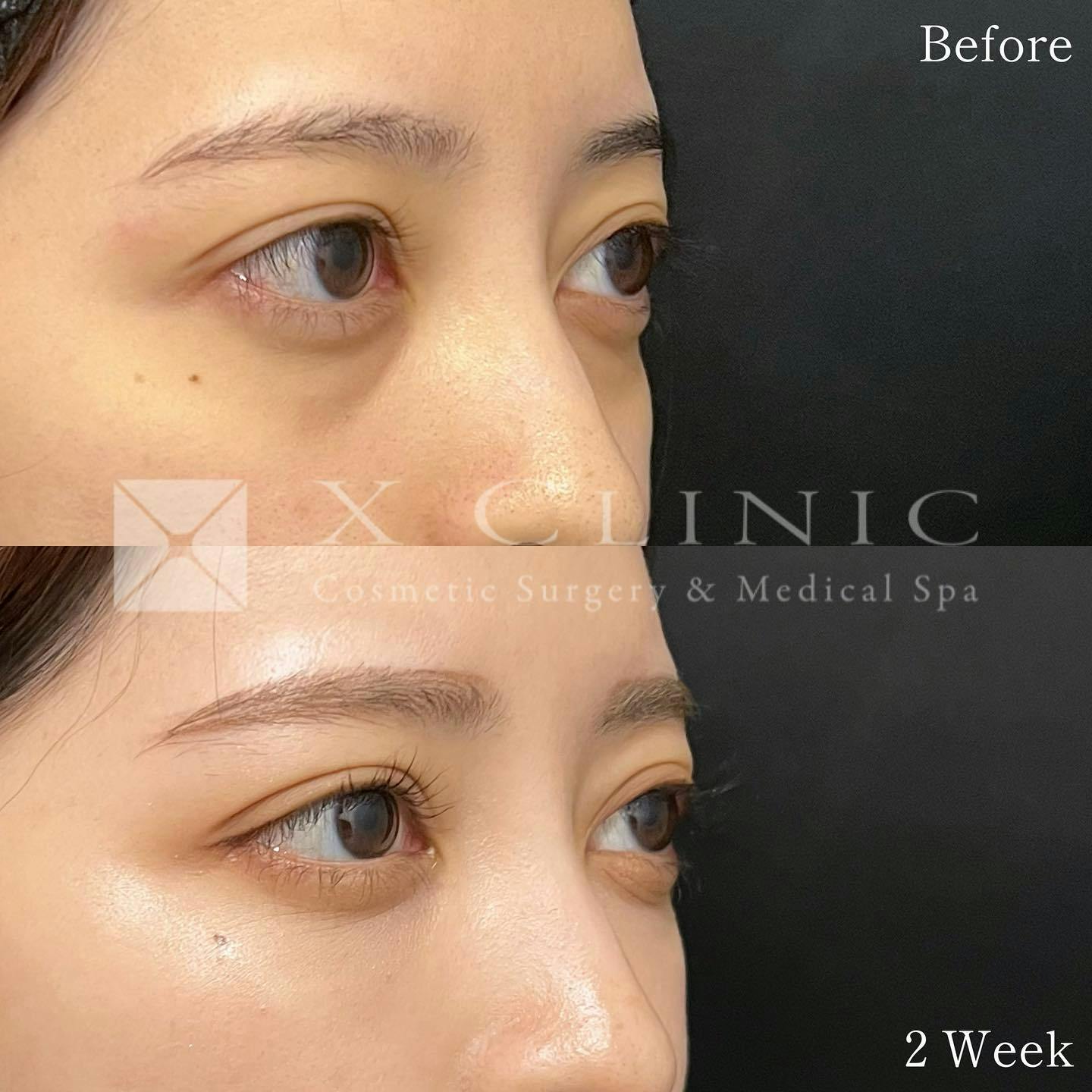 【20代女性・目元】クマ取りフルコース＋エクソソーム_before_aftar