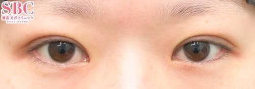 【女性・目元】クイックコスメティーク・トリプルNeo_justafter