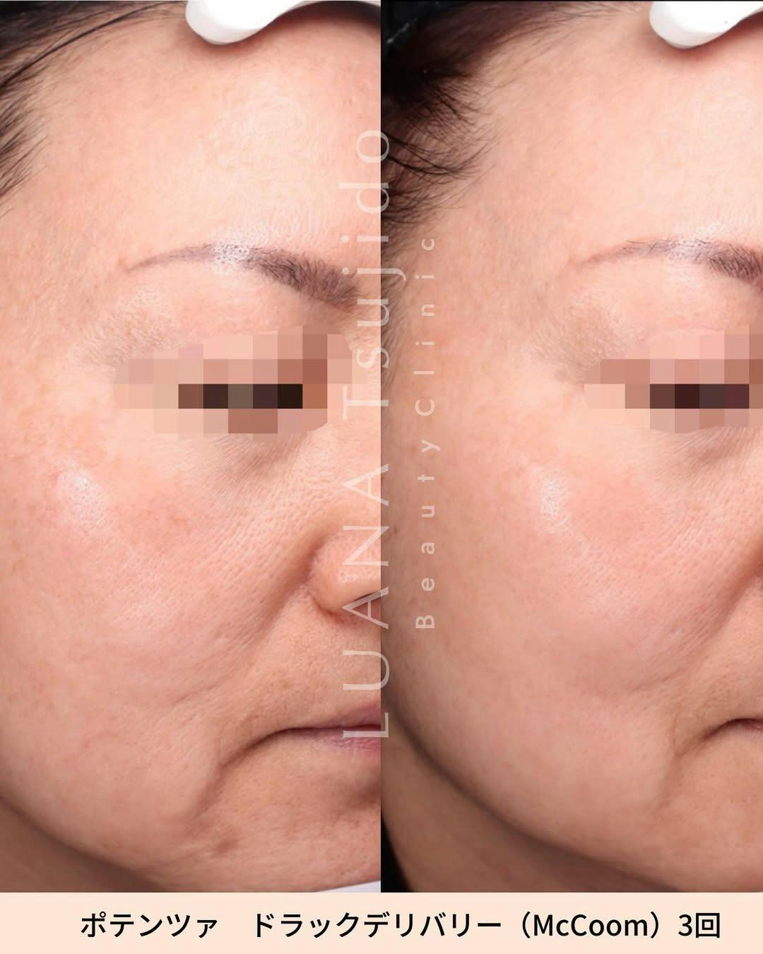 【女性・顔】ポテンツァ　ドラックデリバリー(McCoom)_before_aftar