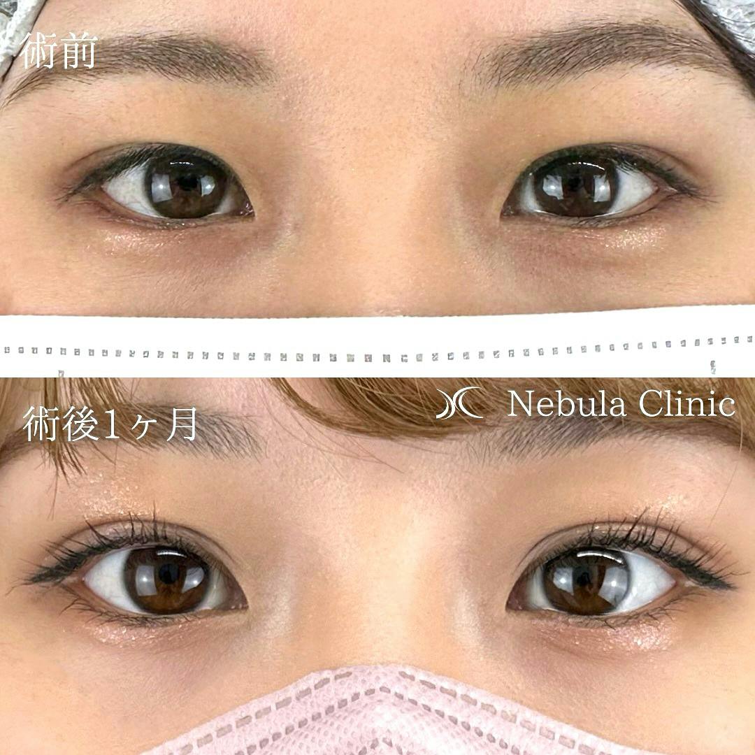 【女性・目元】二重埋没法_before_aftar