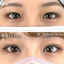 【女性・目元】二重埋没法_before_aftar