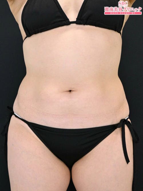 【50代女性・腹部】ダイエット注射 MITI（マイティ）_after