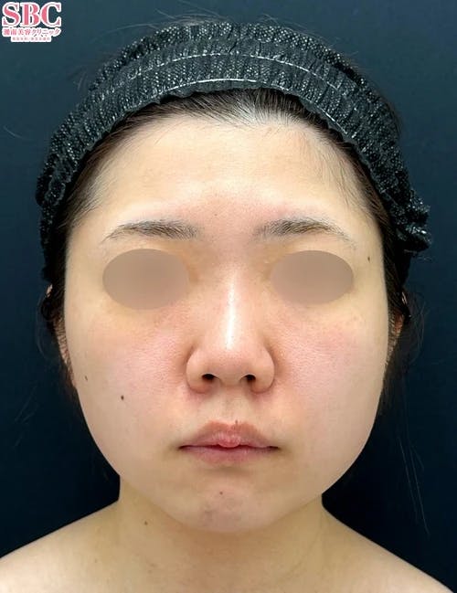 【20代女性・顔】Aquicell(アキーセル)脂肪吸引・根こそぎVASER脂肪吸引・ジョールファット除去術・VOVリフト_before