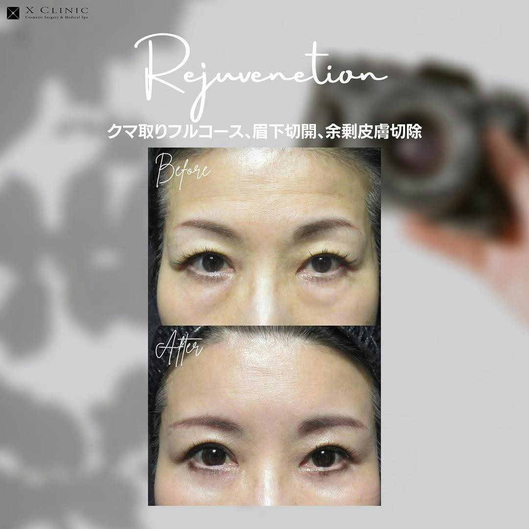 【女性・目元】クマ取りフルコース 眉下切開 余剰皮膚切除_before_aftar