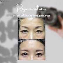 【女性・目元】クマ取りフルコース 眉下切開 余剰皮膚切除_before_aftar