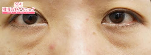 【女性・たるみ】目の下の切らないクマ・たるみ（ふくらみ）取り、切開ハムラ(表ハムラ)法、裏ハムラ法_before