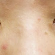 【女性・たるみ】目の下の切らないクマ・たるみ(ふくらみ)取り、切開ハムラ(表ハムラ)法、裏ハムラ法_before