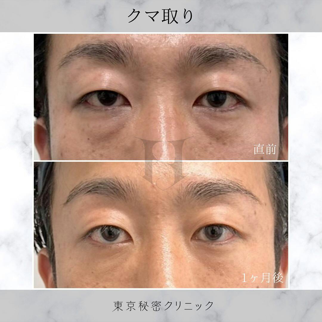 【男性・目元】クマ取り_before_aftar