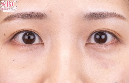 【20代女性・目元】目の下の切らないクマ・たるみ（ふくらみ）取り、ナチュラル脂肪注射コンデンスリッチ、ナチュラル脂肪注射ナノリッチ_1week