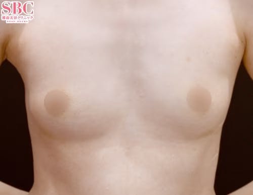 【40代女性・胸】Aquicell（アキーセル）併用セルーション(脂肪注入豊胸)_before