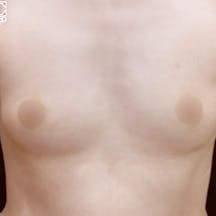 【40代女性・胸】Aquicell(アキーセル)併用セルーション(脂肪注入豊胸)_before