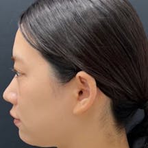 【20代女性・顔】Aquicell(アキーセル)脂肪吸引、ジョールファット除去術、エンブレイスRF、糸リフト_before