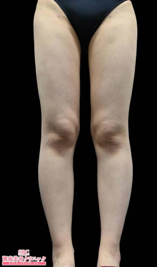 【女性・下半身】根こそぎVASER脂肪吸引(大腿全周＋膝＋臀部)_after