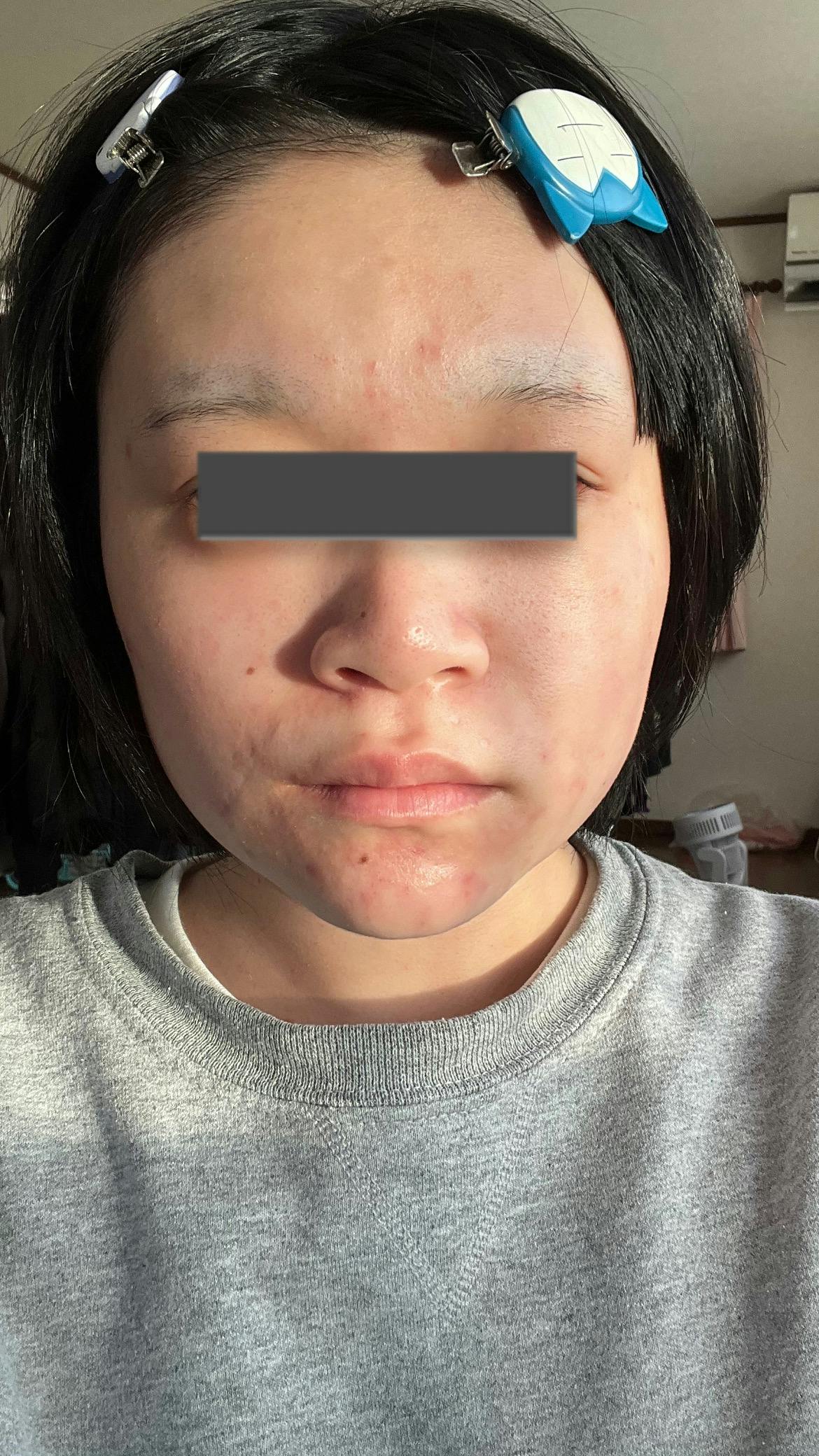 おおたかの森皮フ科で口角ボトックス、サリチル酸ピーリング、医療脱毛(VIO)を受けたゆかさんの写真