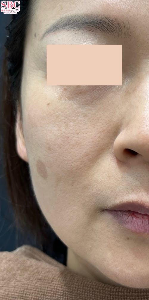 【女性・顔・ほうれい線】ヒアルロン酸ジュビダームビスタ バイクロスシリーズ・VOV(ボブ)リフト・シークレットリフト_before