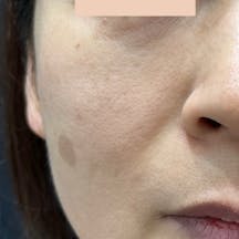 【女性・顔・ほうれい線】ヒアルロン酸ジュビダームビスタ バイクロスシリーズ・VOV(ボブ)リフト・シークレットリフト_before