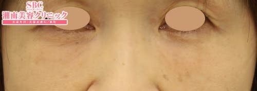 【女性・目元】ナチュラル脂肪注射コンデンスリッチ、目の下の切らないクマ・たるみ（ふくらみ）取り_aftar