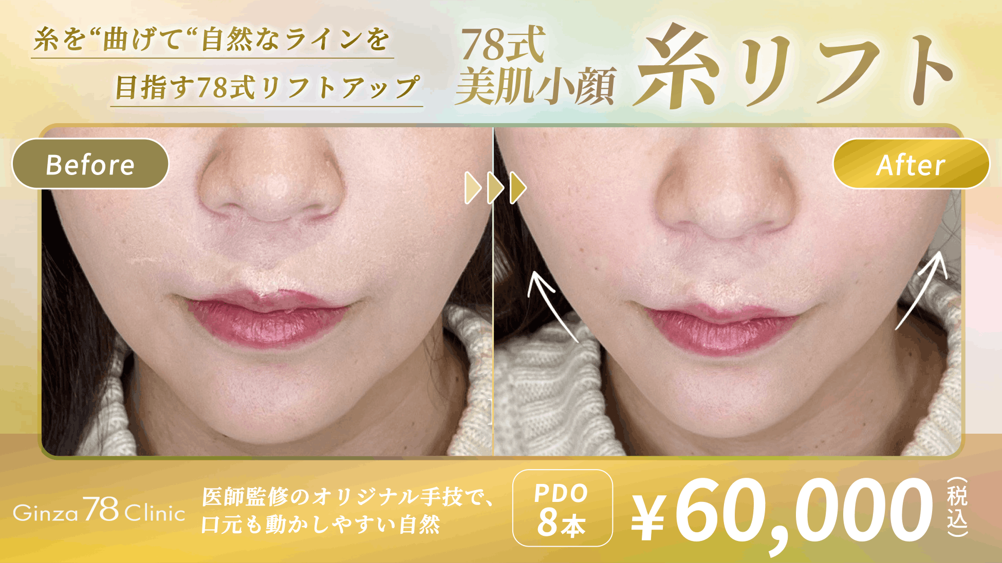 整膚美容大全(定価35000円) Ginza78Clinic(銀座セブンエイトクリニック)】78式美肌小顔糸