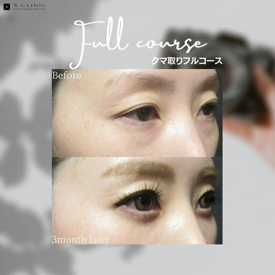 【女性・目元】クマ取りフルコース_before_aftar