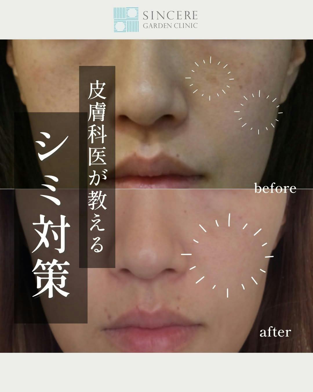 【女性・シミ】レーザートーニング（肝斑治療） ルメッカ_before_aftar