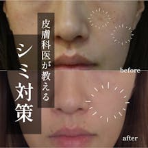 【女性・シミ】レーザートーニング(肝斑治療) ルメッカ_before_aftar