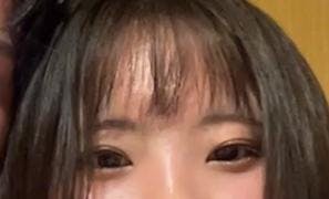 湘南美容クリニック 上野院で二重埋没法：フォーエバー二重術を受けたみーさんの写真