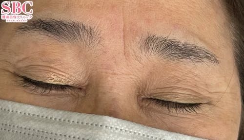 【女性・眉】アートメイク(眉毛)_before