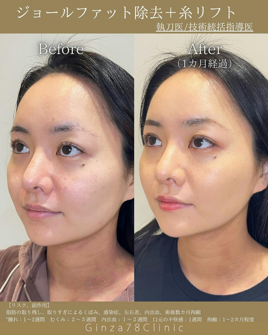 【女性・たるみ】ジョールファット除去_before_aftar