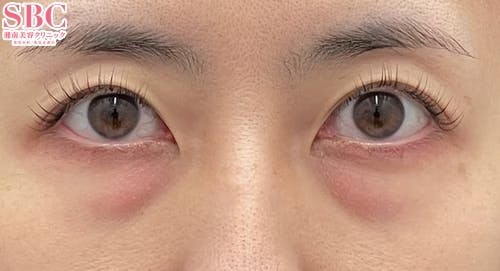 【女性・目元】目の下の切らないクマ・たるみ（ふくらみ）取り、ナチュラル脂肪注射コンデンスリッチ、ナチュラル脂肪注射ナノリッチ_before