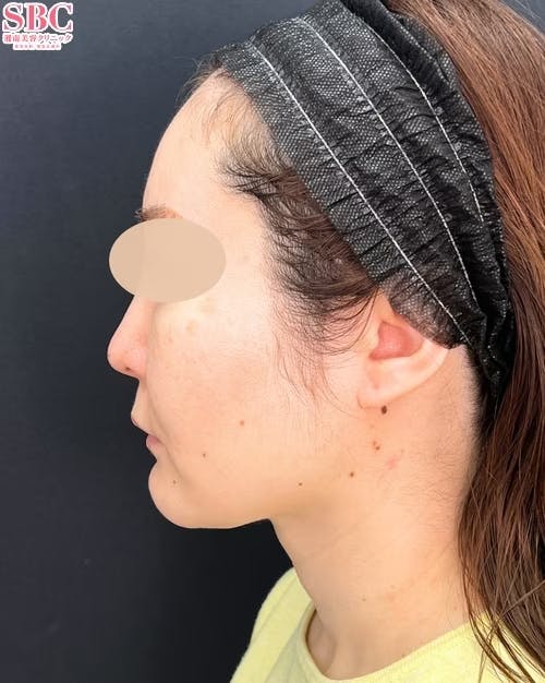 【女性・小顔】根こそぎVASER脂肪吸引、ジョールファット除去術、メーラーファット除去術_after