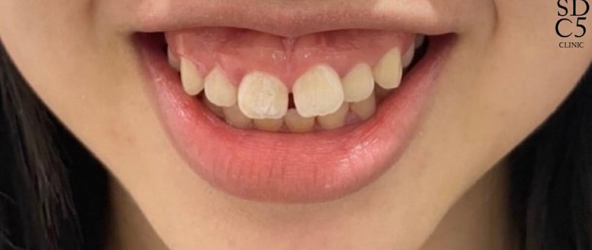 【女性・口元】ガミースマイルボトックス_b1