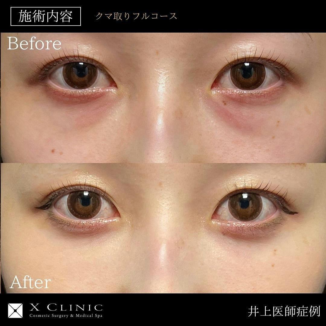 【女性・目元】クマ取りフルコース(クマ取り＋コンデンス＋ナノファット)_before_aftar