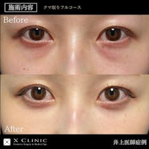 【女性・目元】クマ取りフルコース(クマ取り+コンデンス+ナノファット)_before_aftar