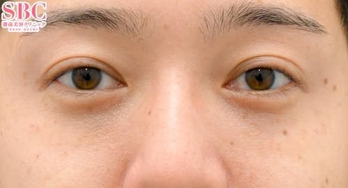 【目元】目の下の切らないクマ・たるみ（ふくらみ）取り、ナチュラル脂肪注射コンデンスリッチ_after