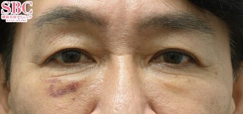 【男性・目元】目の下の切らないクマ・たるみ（ふくらみ）取り、ナチュラル脂肪注射コンデンスリッチ、ナチュラル脂肪注射ナノリッチ_1week