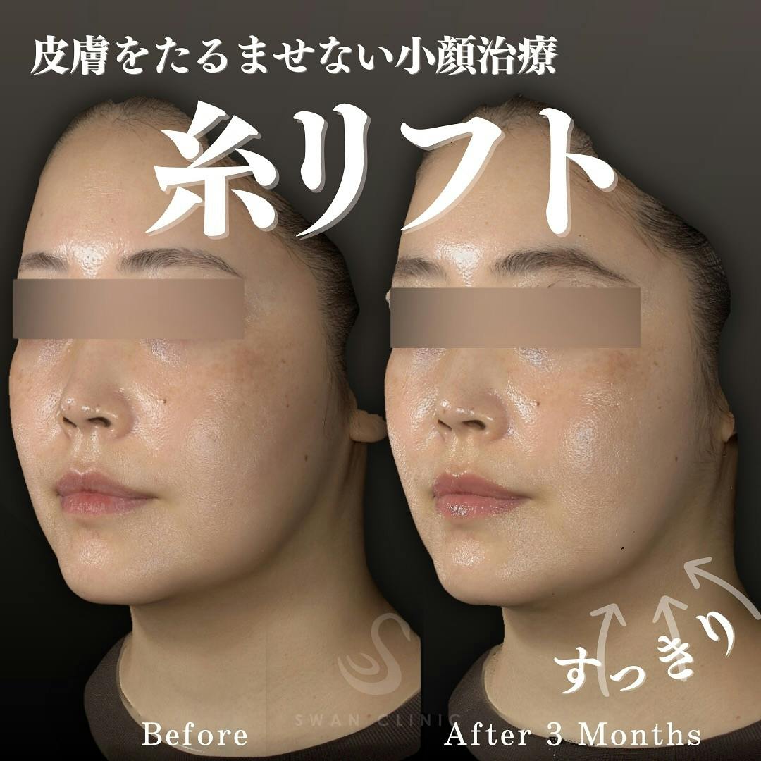 【女性・小顔】糸リフト 口横サーマジェント ロ角ヒアルロン酸注入_before_aftar