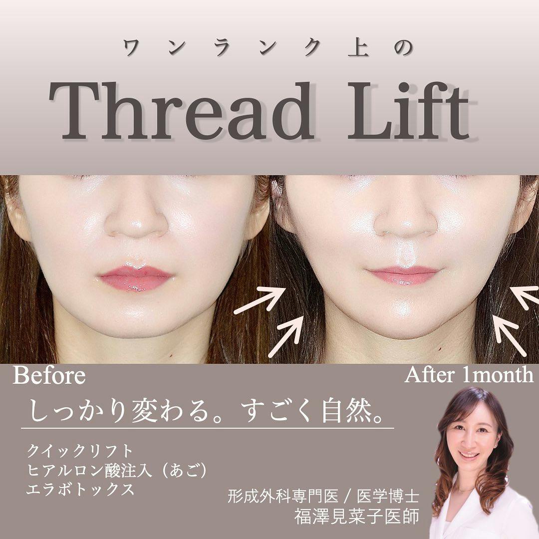 【女性・眉】クイックリフト、エラボトックス、ヒアルロン酸（顎）_before_aftar