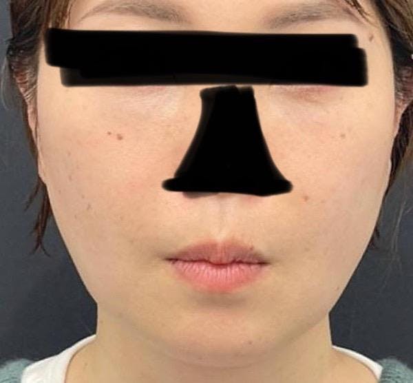 X CLINIC (エックスクリニック)  恵比寿院でクマ取り・目の下のたるみ取り(クマ治療)：クマ取りフルコース+高濃度PRPを受けたI-子ちゃんさんの写真