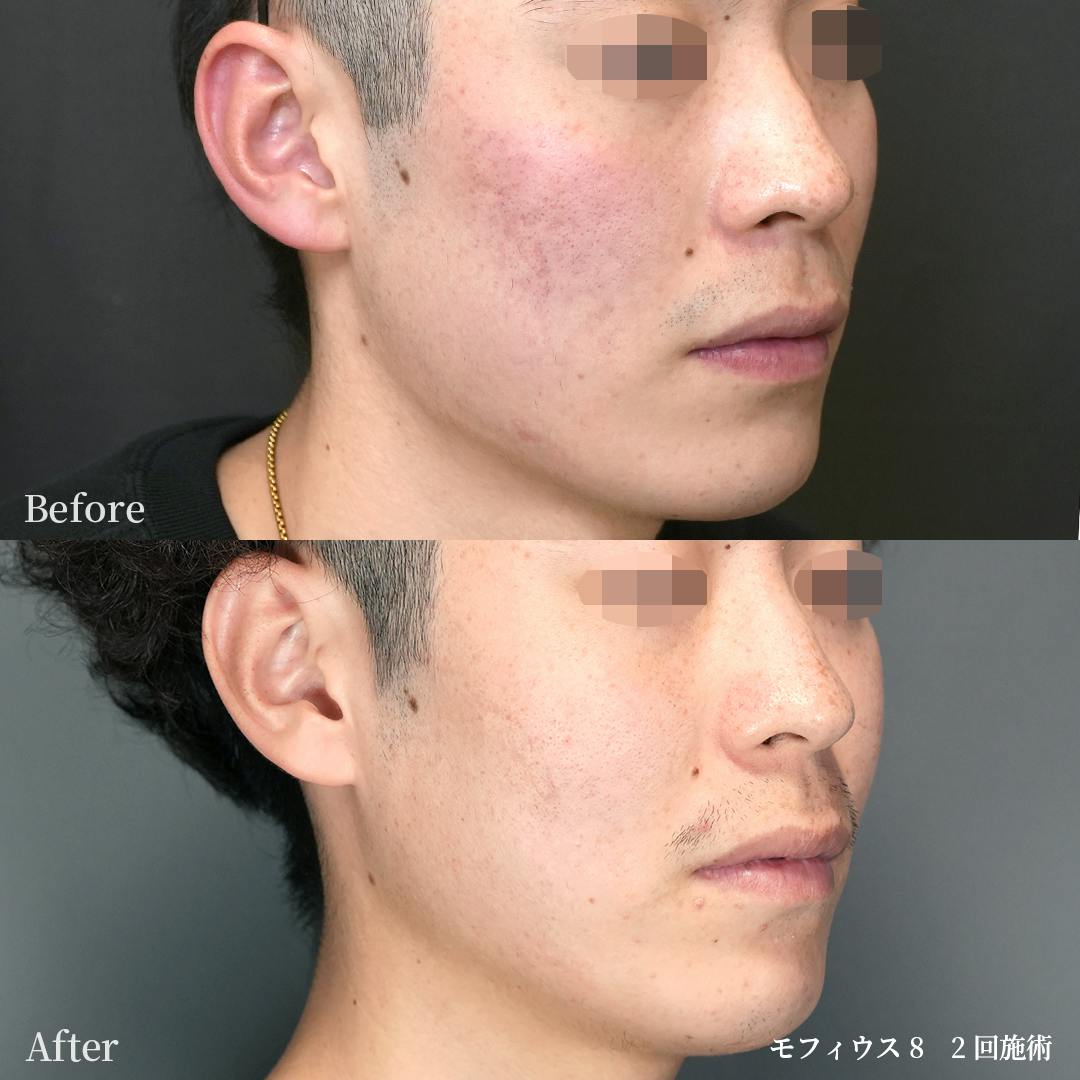 モフィウス_before_after