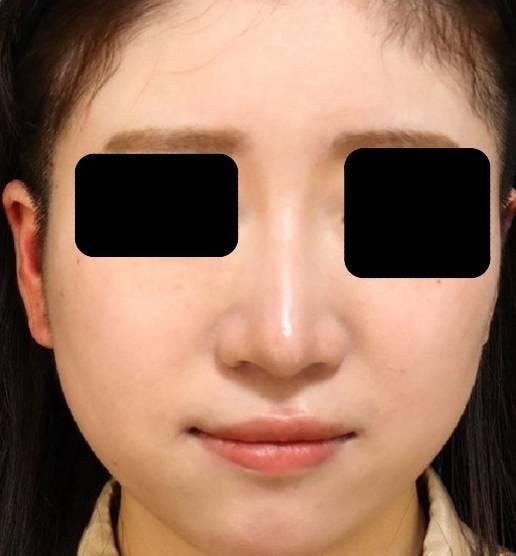 品川美容外科銀座院でプレミアム隆鼻術：ダンゴ鼻（鼻先）修整を受けた柏餅さんの写真