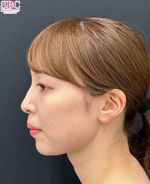 【20代女性・顔】Aquicell(アキーセル)脂肪吸引・ジョールファット除去術・エンブレイスRF_after