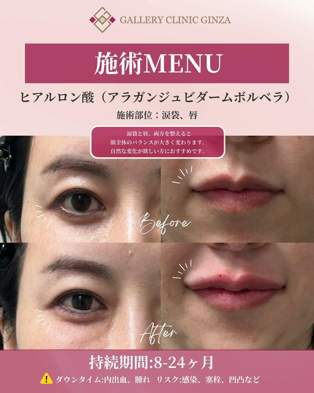 【女性・顔】ヒアルロン酸(涙袋・唇)_before_aftar