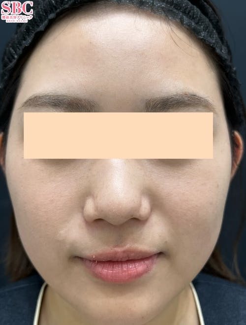 【女性・顔】フォトRF、ケミカルピーリング、エレクトロポレーション(イオン導入)_after