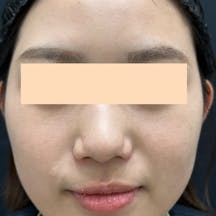 【女性・顔】フォトRF、ケミカルピーリング、エレクトロポレーション(イオン導入)_after